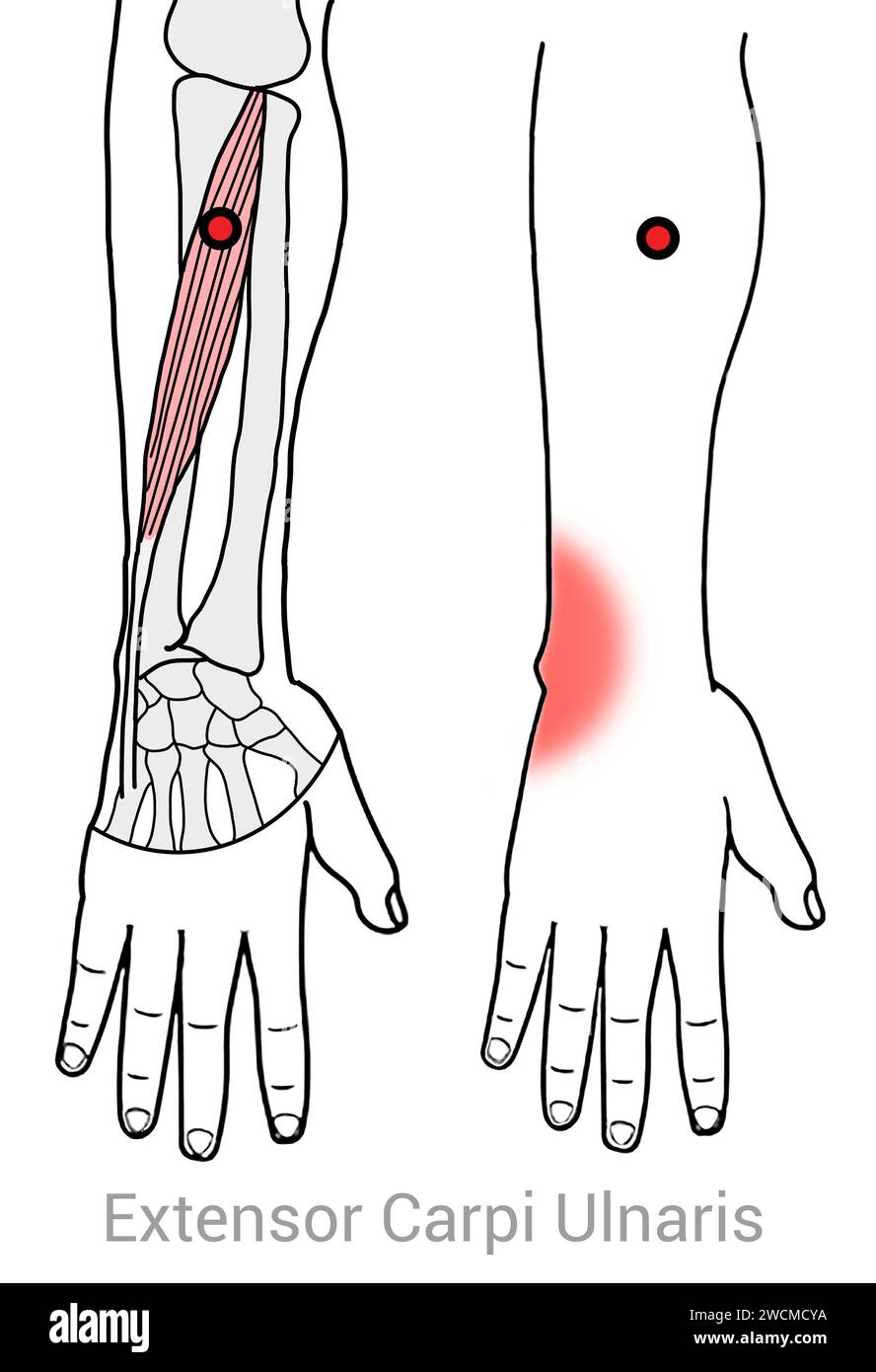 Extensor Carpi Ulnaris: Myofascial trigger points and associated pain locations Stock Photo