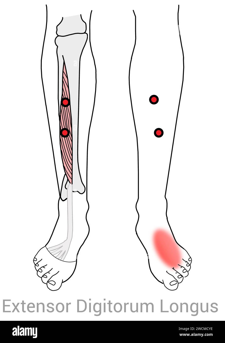 Extensor Digitorum Longus: Myofascial trigger points and associated pain locations Stock Photo