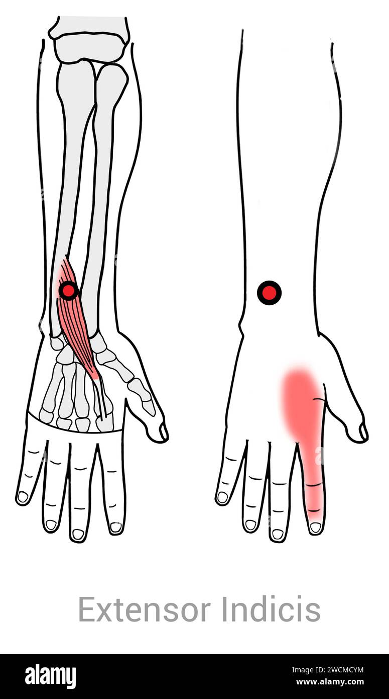 Extensor Indicis Myofascial trigger points and associated pain