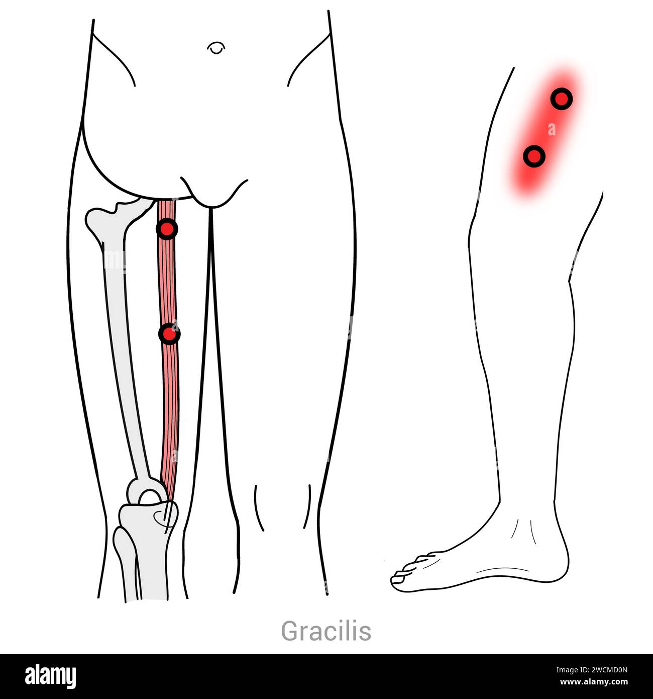 Gracilis: Myofascial trigger points and associated pain locations Stock Photo