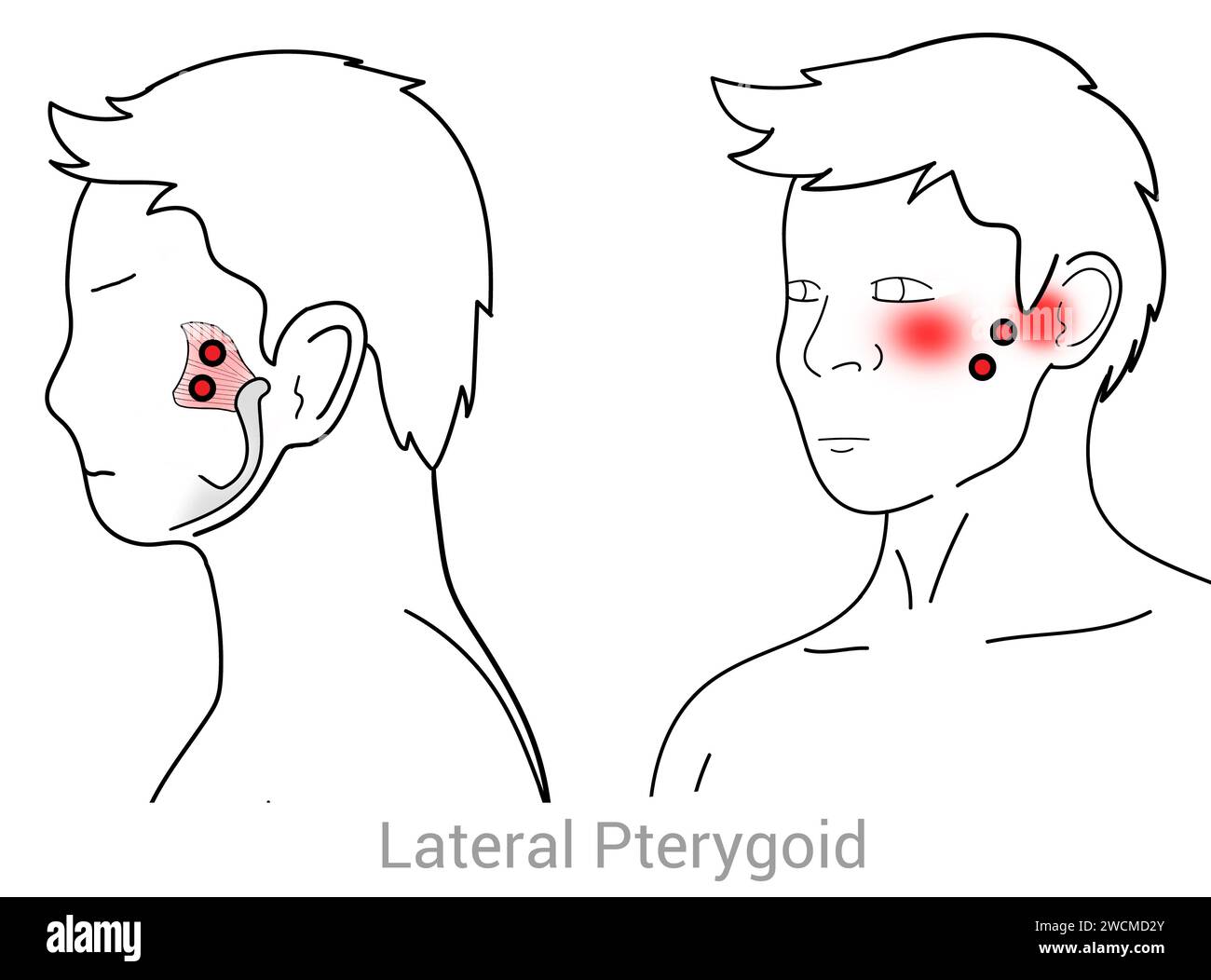 Lateral Pterygoid: Myofascial trigger points and associated pain locations Stock Photo