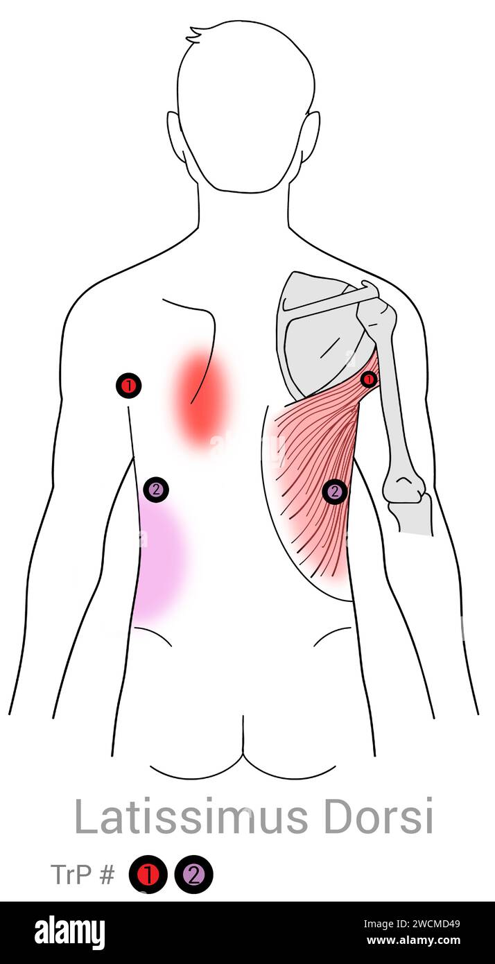 Latissimus Dorsi: Myofascial trigger points and associated pain ...