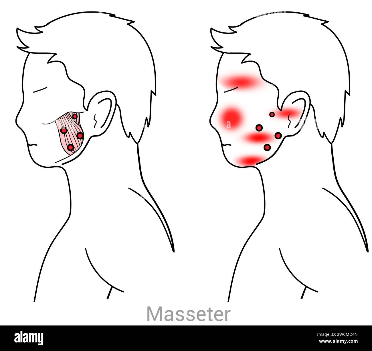 Masseter: Myofascial trigger points and associated pain locations Stock Photo