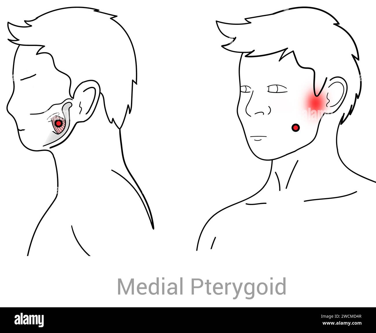 Medial Pterygoid: Myofascial trigger points and associated pain locations Stock Photo