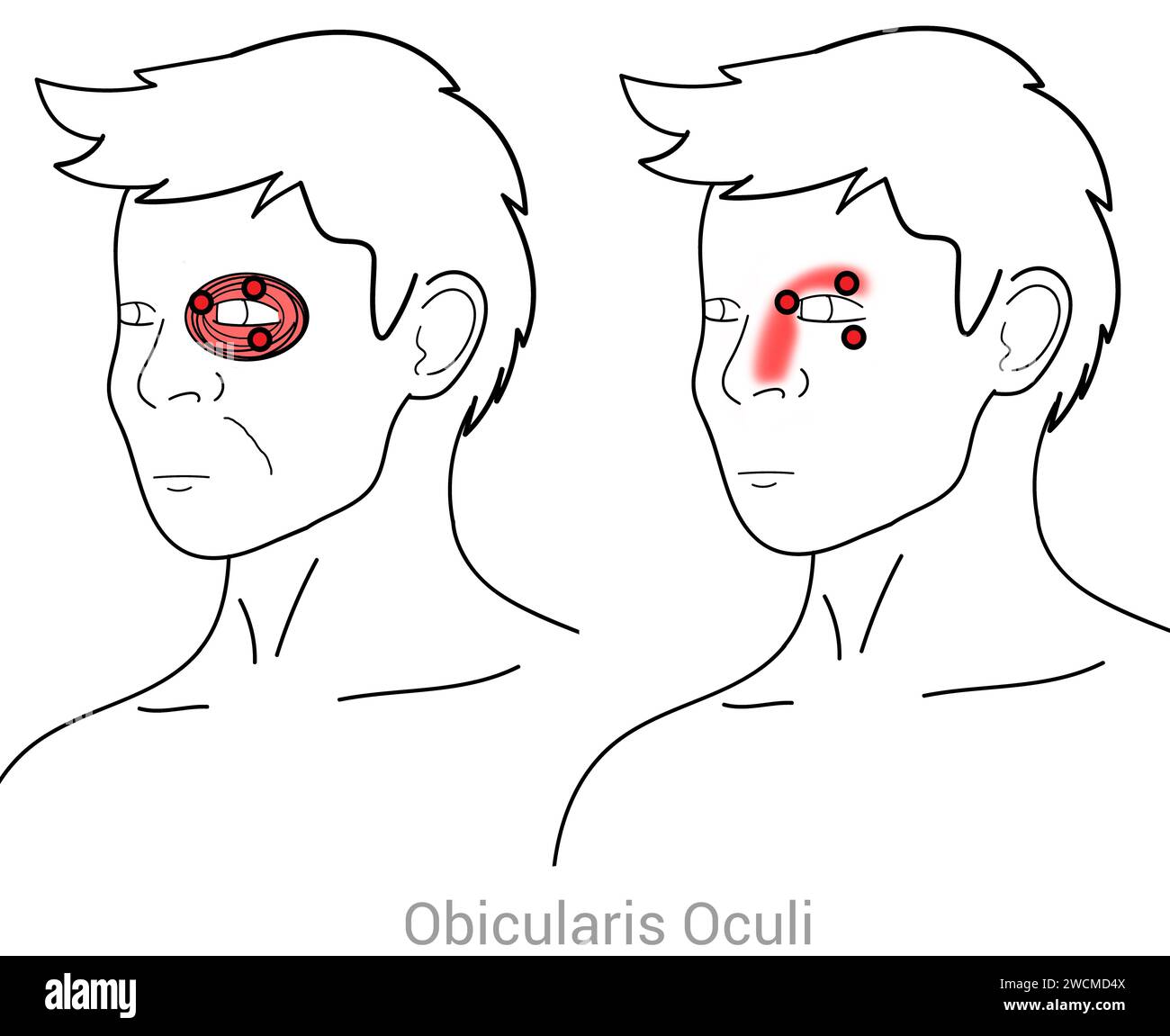Obicularis Oculi: Myofascial trigger points and associated pain locations Stock Photo