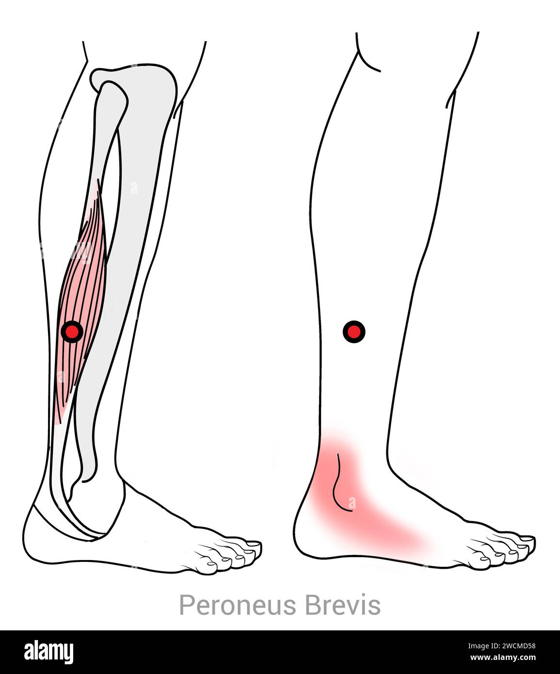 Peroneus Brevis: Myofascial trigger points and associated pain locations Stock Photo