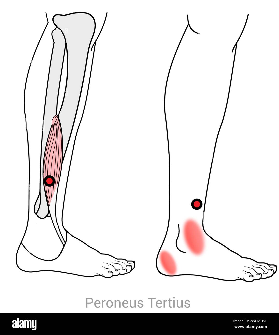 Peroneus Tertius: Myofascial trigger points and associated pain locations Stock Photo