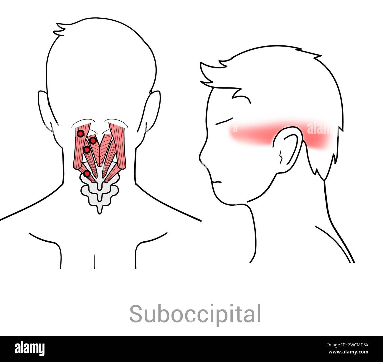 Suboccipitals Myofascial trigger points and associated pain locations Stock Photo Alamy