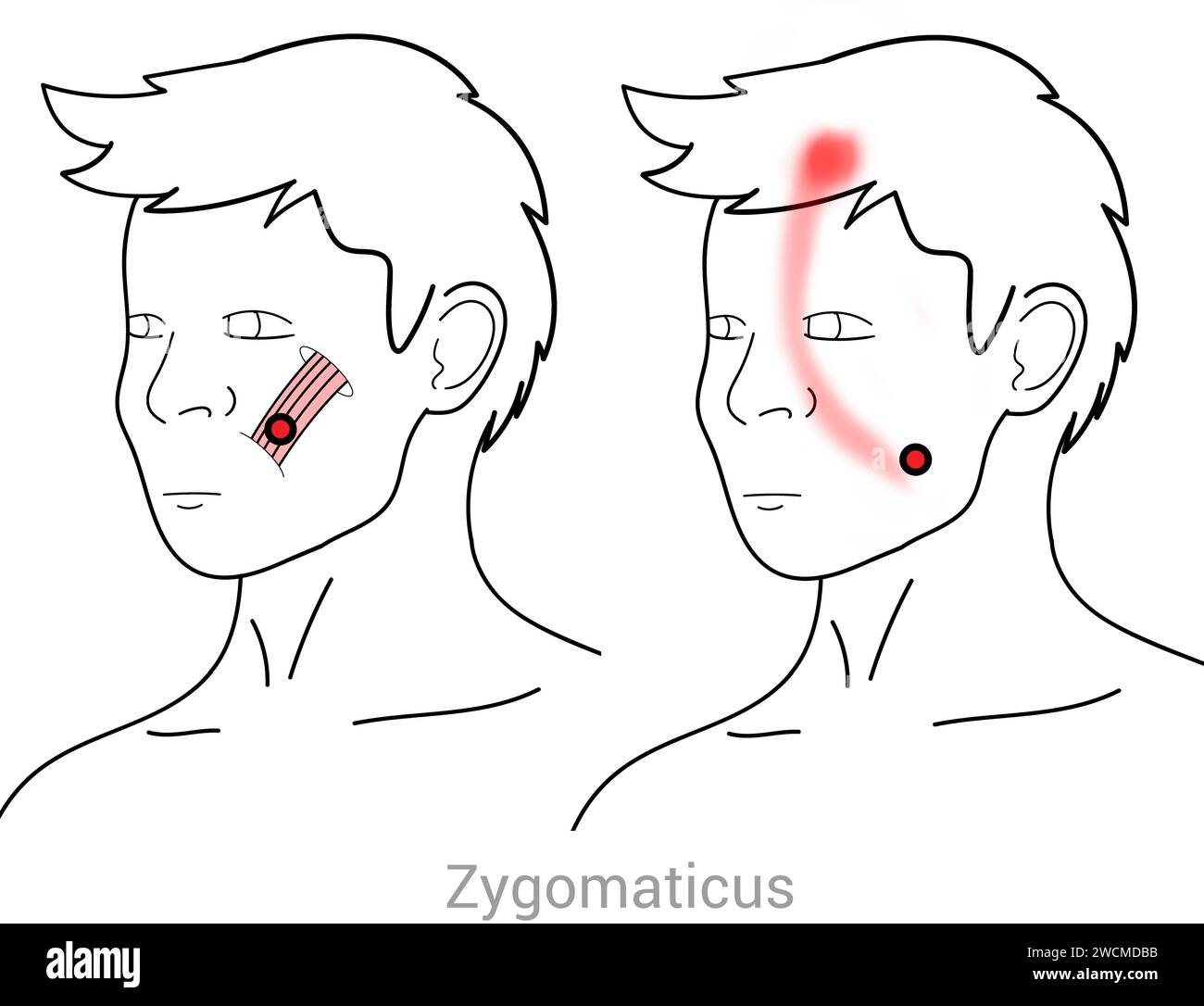 Zygomaticis Myofascial trigger points and associated pain locations