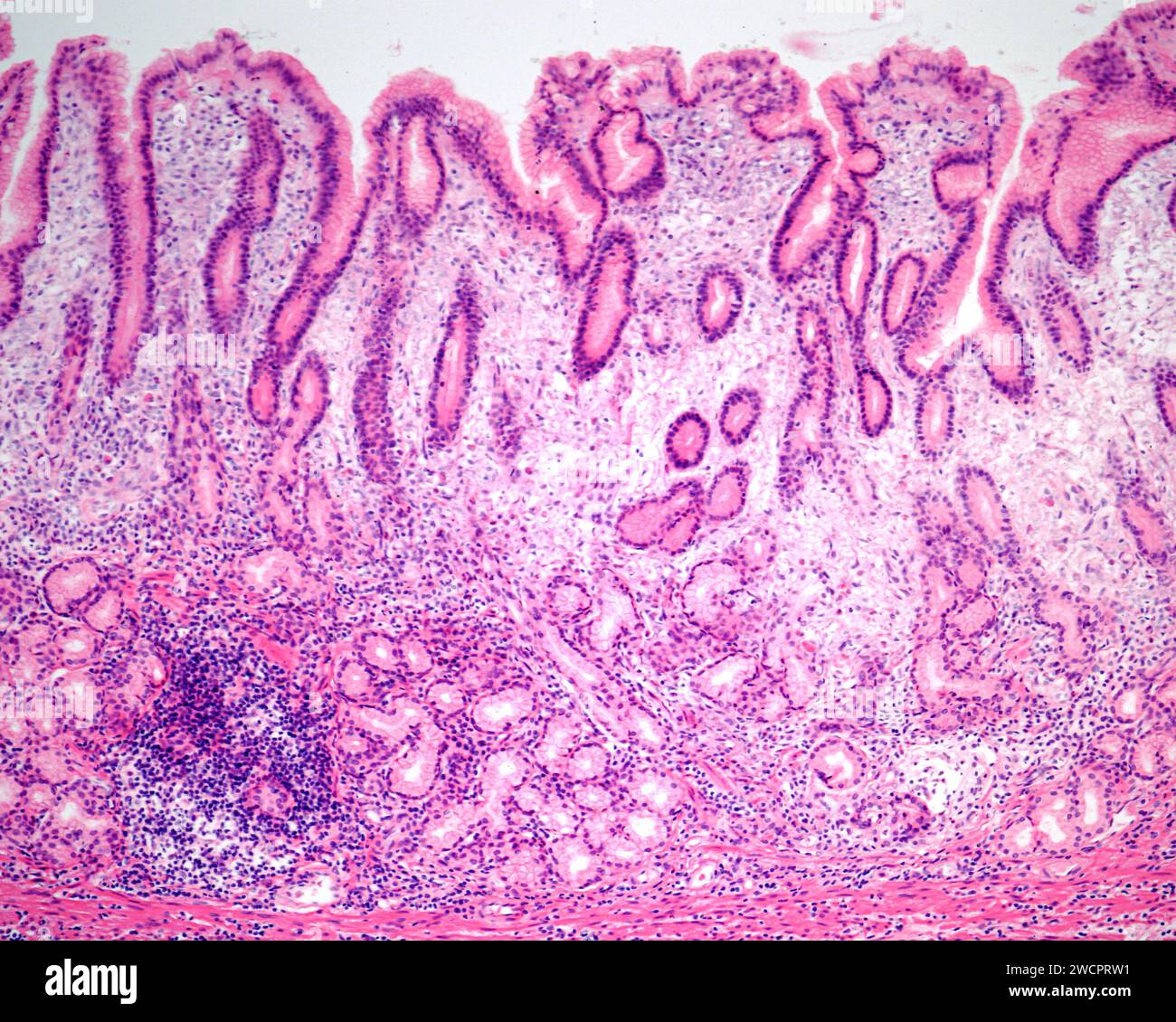Chronic Gastritis Light Micrograph Stock Photo Alamy chronic-gastritis-light-micrograph-stock-photo-alamy