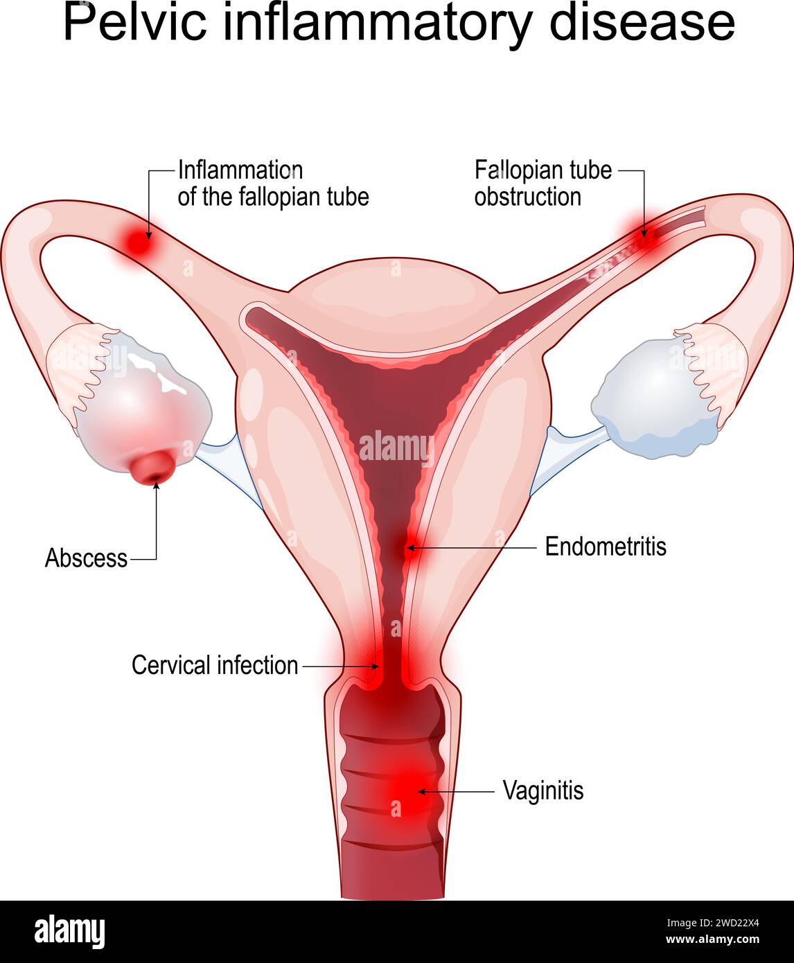 Pelvic inflammatory disease. Cross section of a Uterus with symptoms of Inflammation, fallopian tube obstruction, endometritis, salpingitis, tubo-ovar Stock Vector