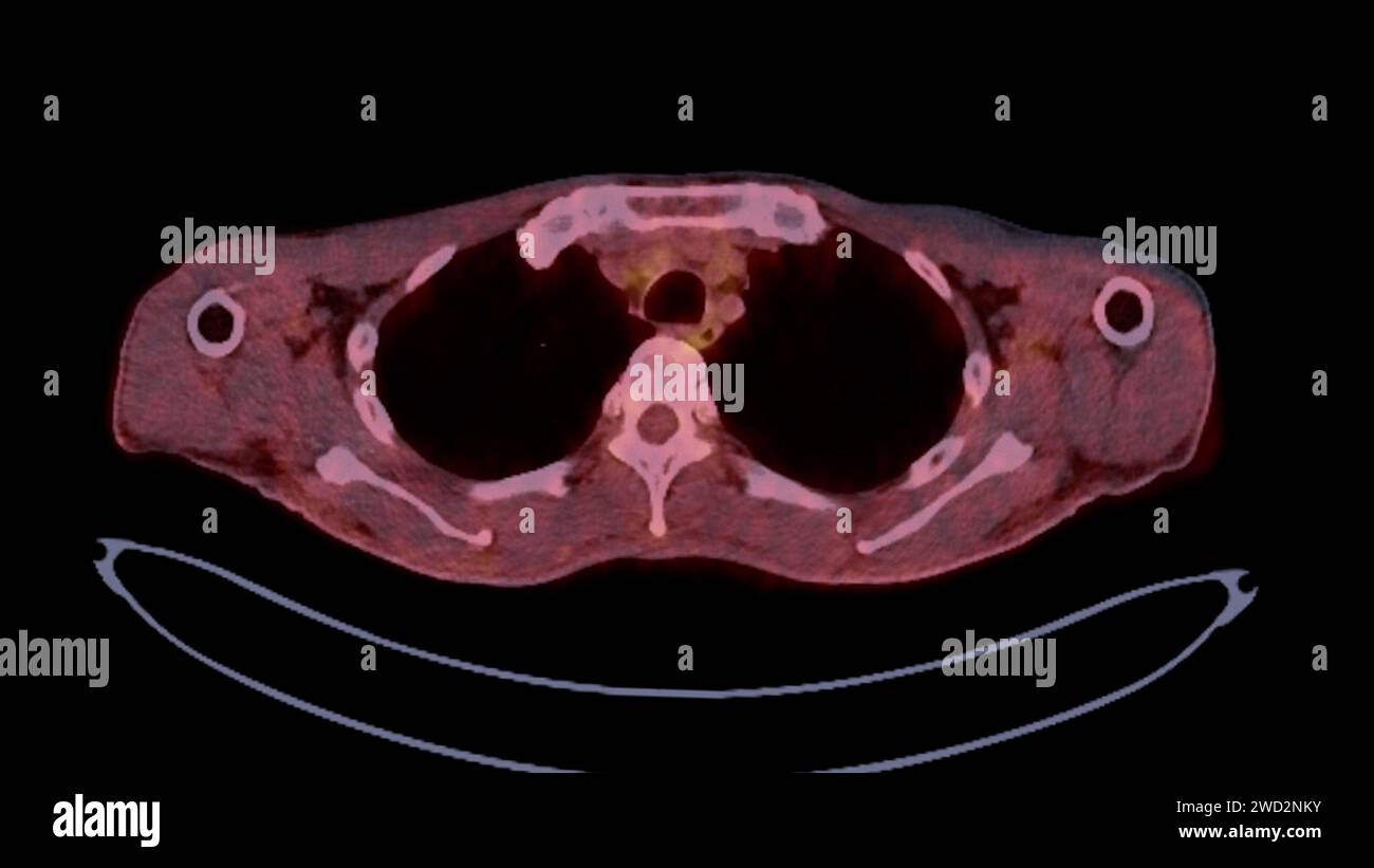 A PET-CT scan image is a diagnostic visualization combining Positron ...