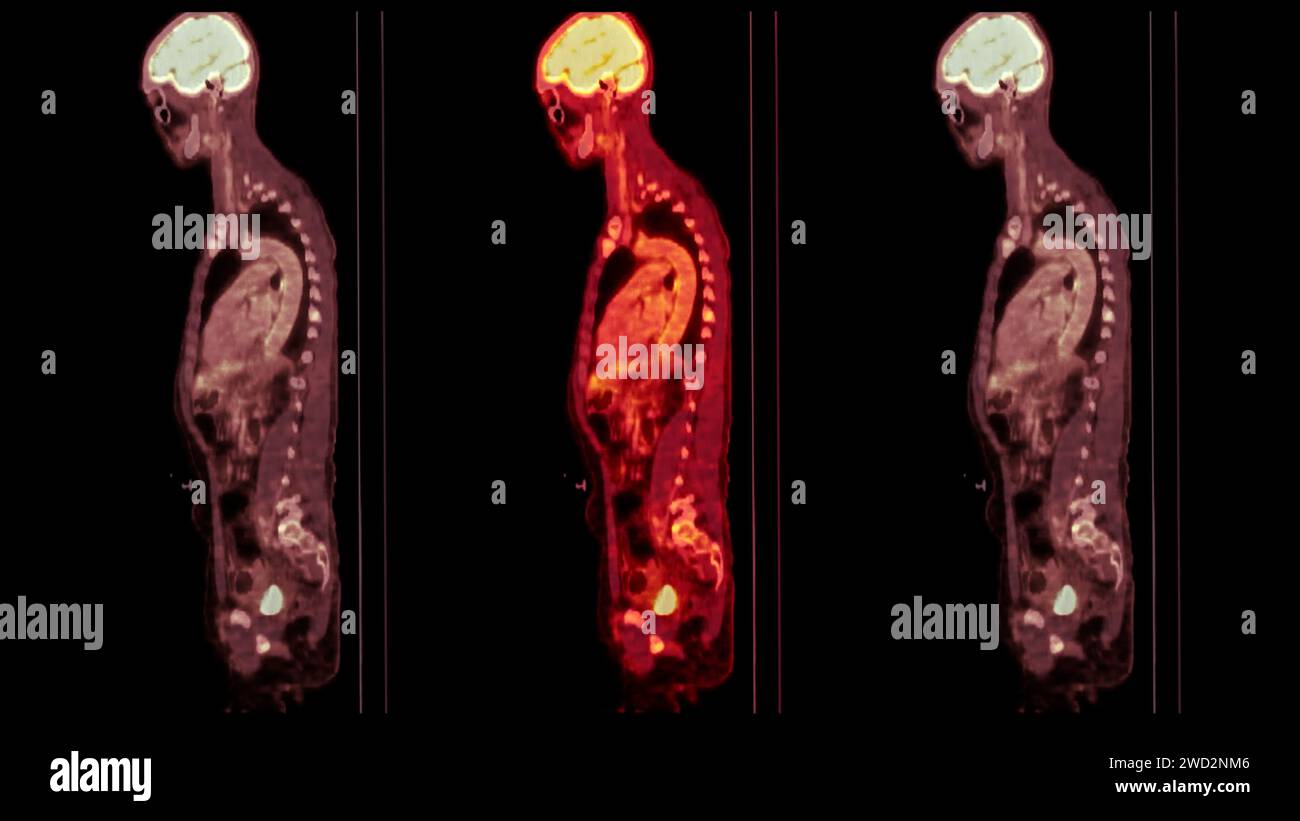Carcinoma in situ hi-res stock photography and images - Alamy