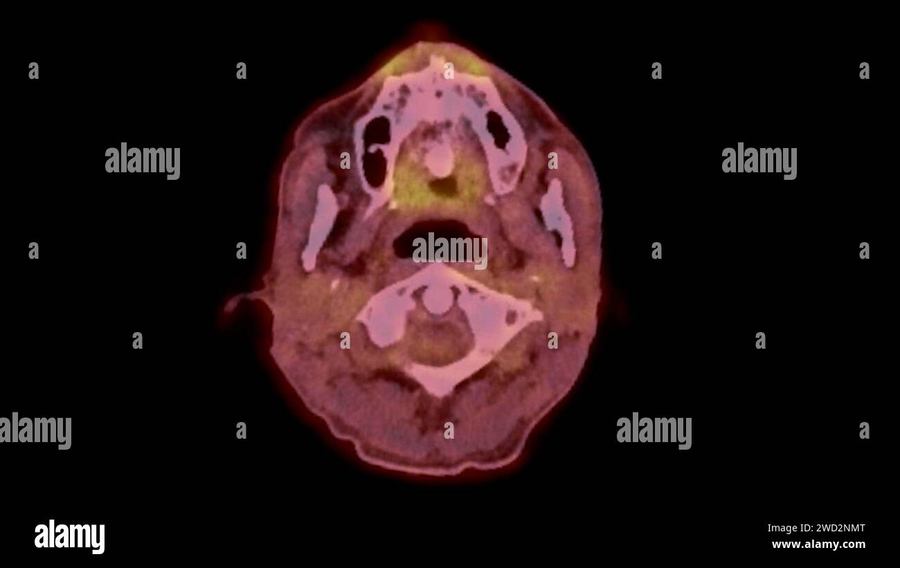 A PET-CT scan image is a diagnostic visualization combining Positron ...