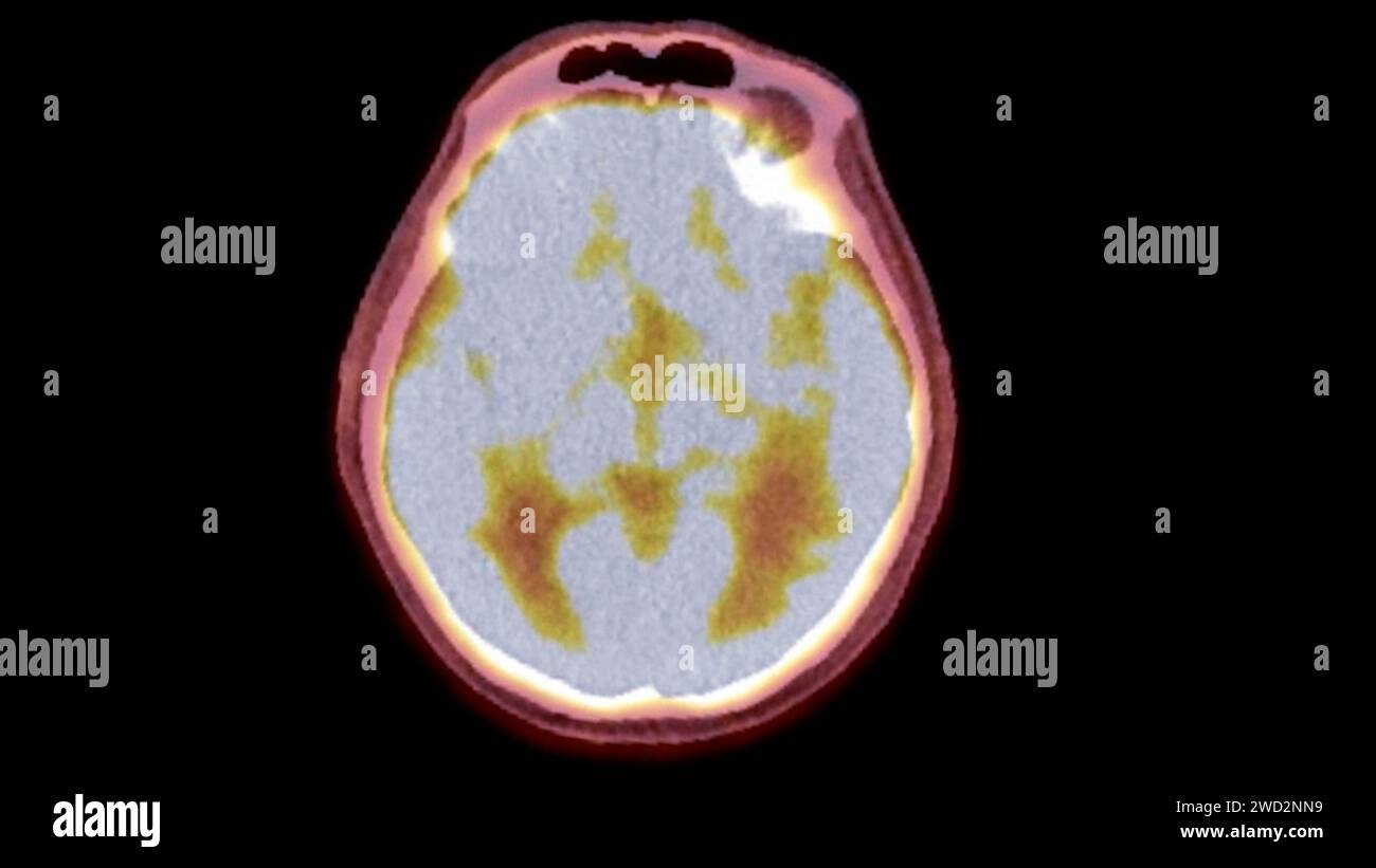 Pet ct anatomy hi-res stock photography and images - Alamy