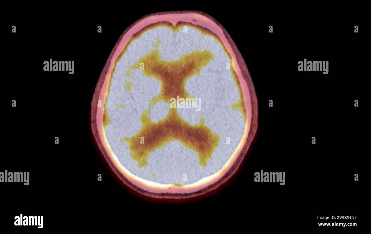A PET-CT scan image is a diagnostic visualization combining Positron ...
