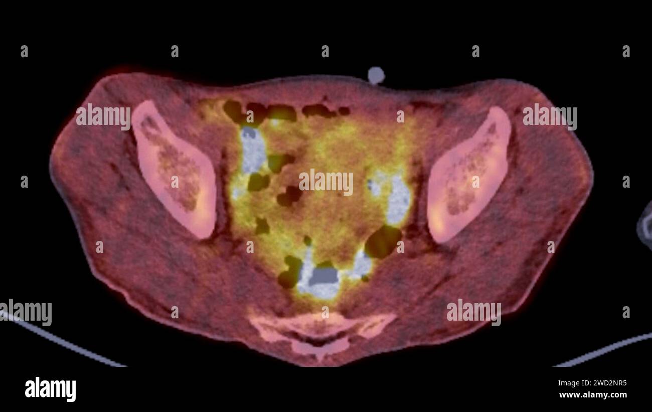 A PET-CT scan image is a diagnostic visualization combining Positron Emission Tomography (PET) and Computed Tomography (CT) for Helps in finding cance Stock Photo