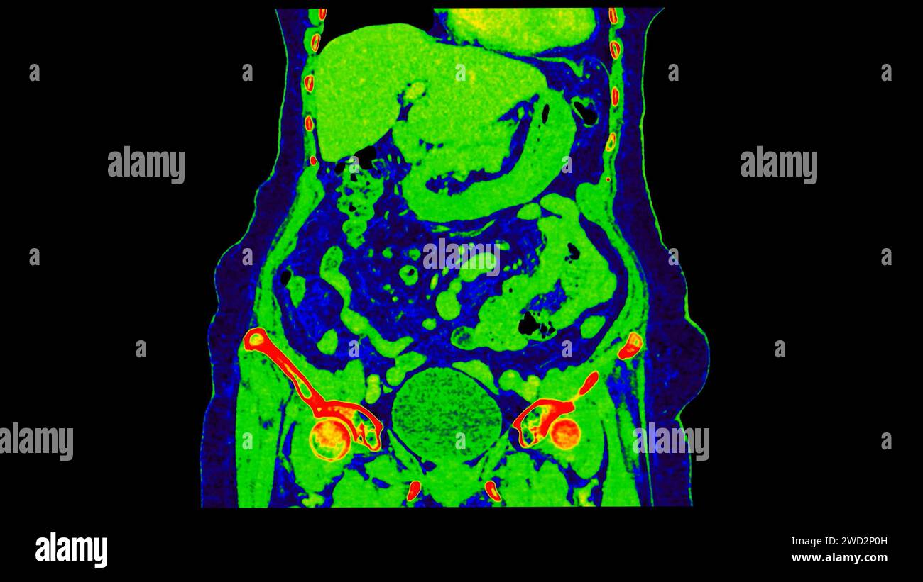 CT scan of Abdomen coronal view with injection contrast media with ...