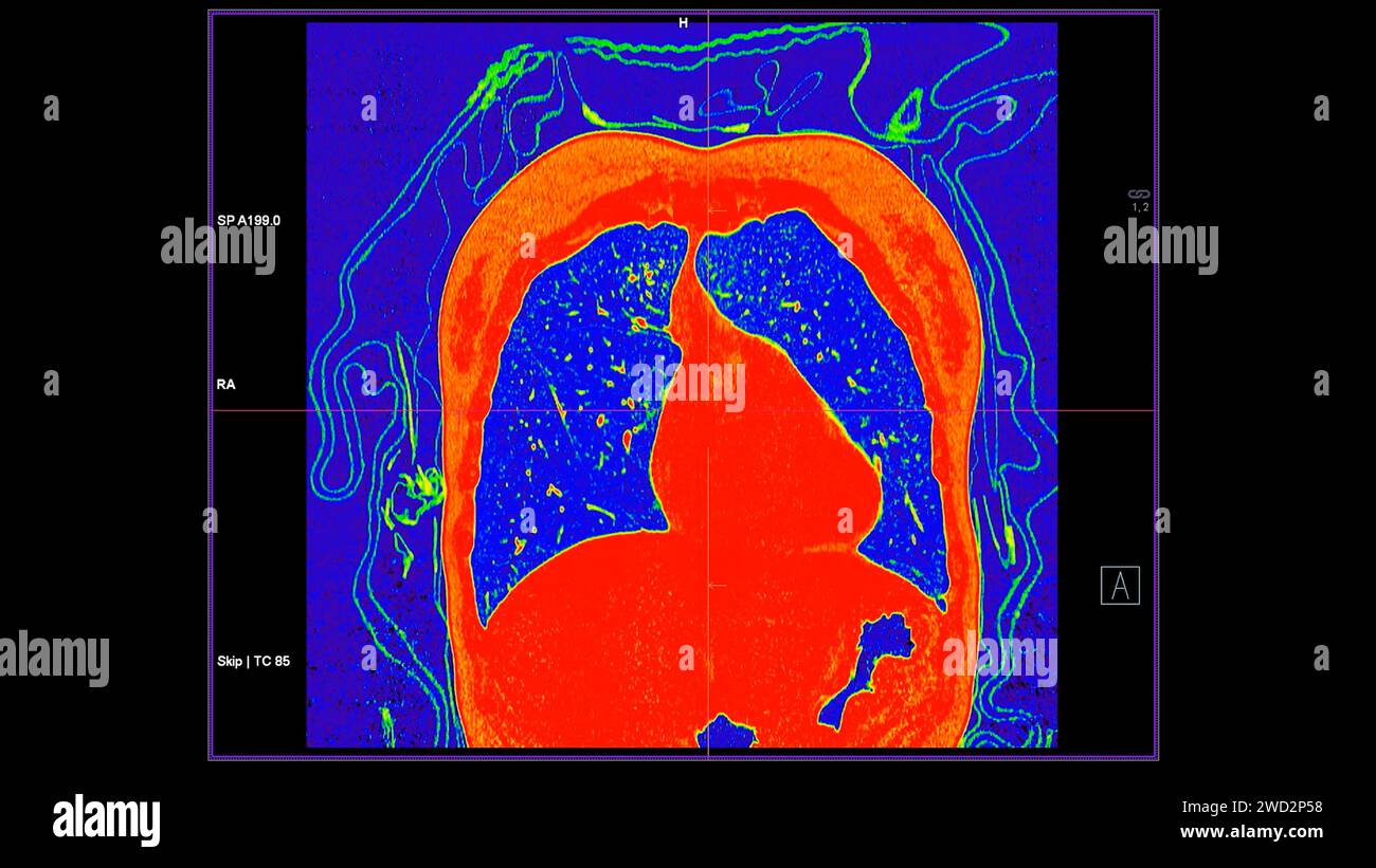 CT scan of Chest coronal view in color mode  for diagnostic Pulmonary embolism (PE) , lung cancer and covid-19. Stock Photo