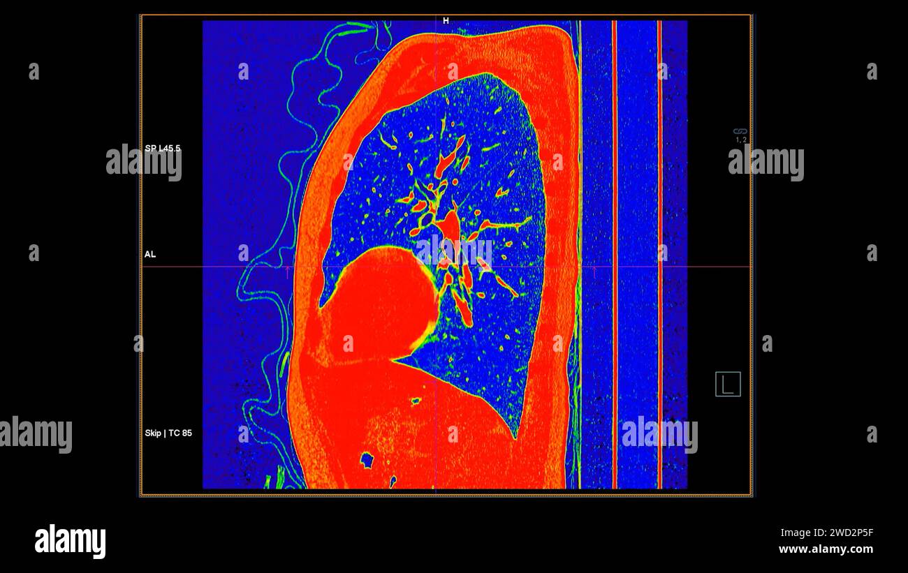 CT scan of Chest sagittal view in color mode for diagnostic Pulmonary ...
