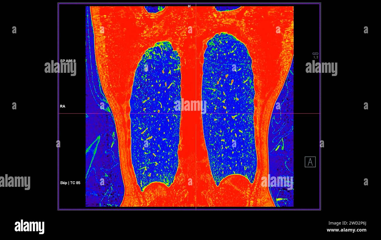 CT scan of Chest coronal view in color mode  for diagnostic Pulmonary embolism (PE) , lung cancer and covid-19. Stock Photo