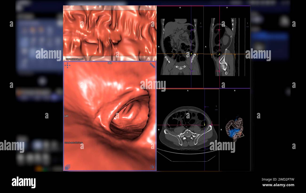 CT colonography , This imaging technique is often employed for