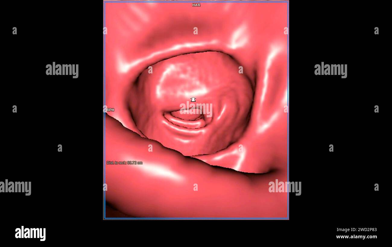 CT colonography , This imaging technique is often employed for colorectal cancer screening