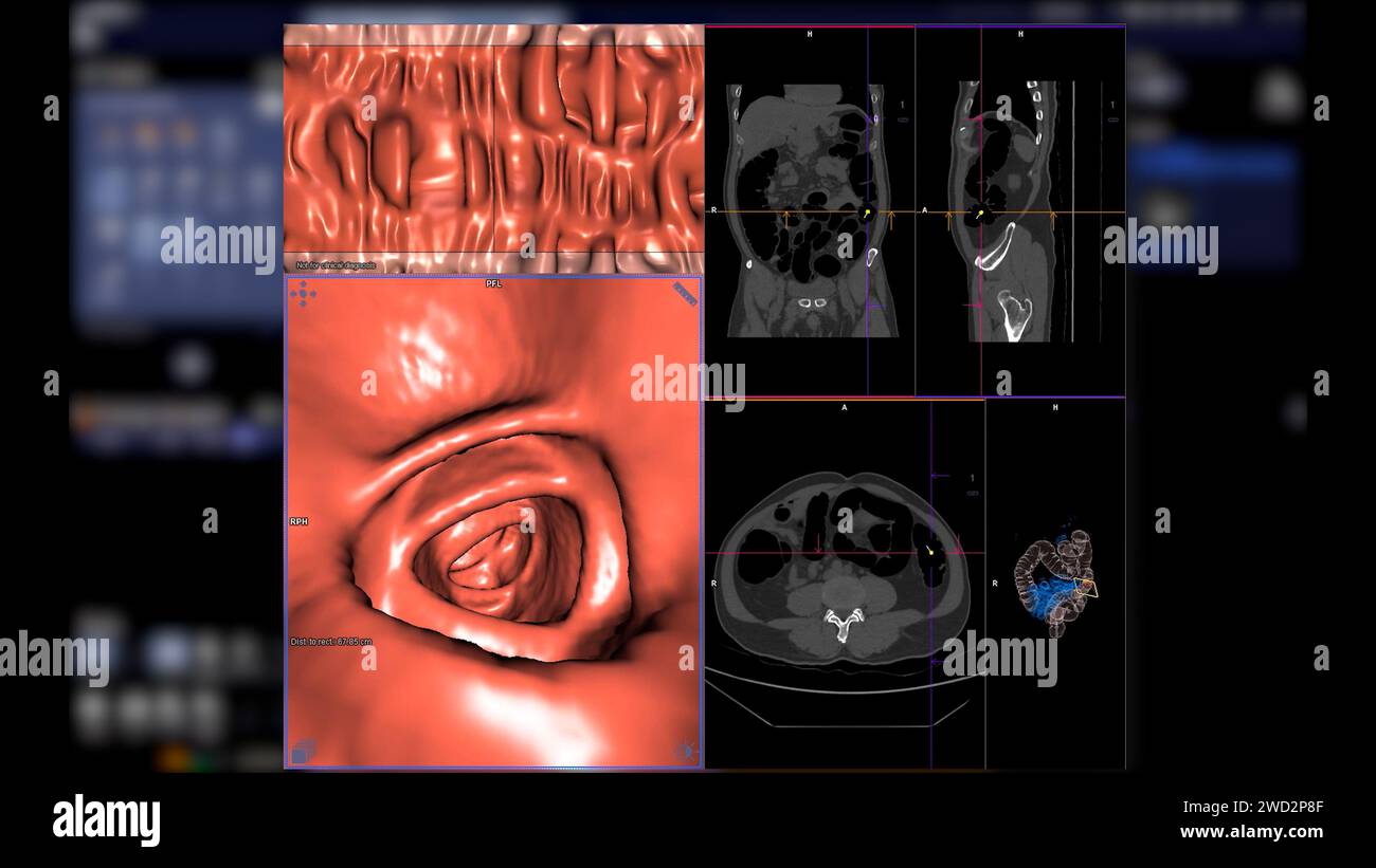 CT colonography , This imaging technique is often employed for colorectal cancer screening, providing detailed images of the colon's interior 3D rende Stock Photo