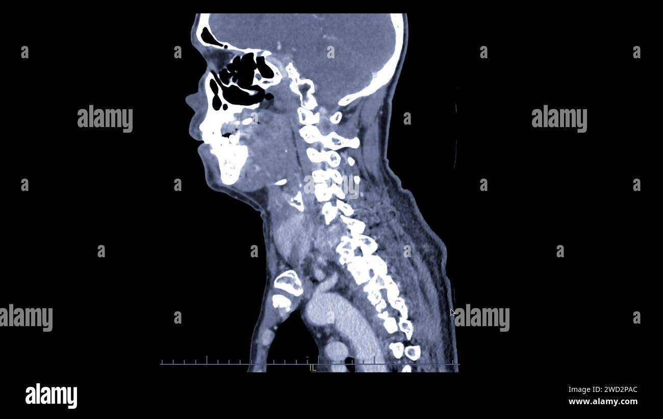 A CT scan of the neck sagittal view for diagnostic technique is essential for evaluating cervical vertebrae, soft tissues, and detecting abnormalities Stock Photo