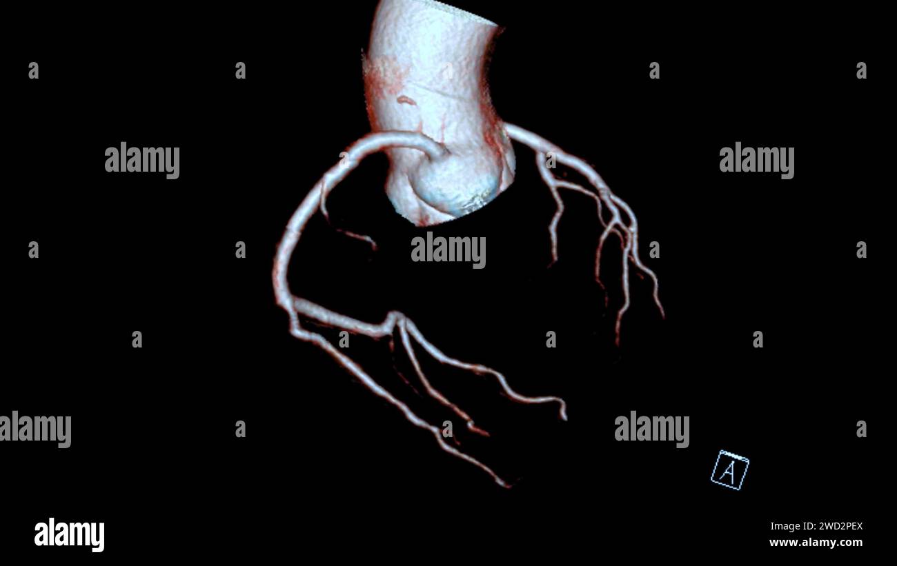 CTA coronary artery 3D rendering is a diagnostic imaging technique capturing detailed visuals of the heart's blood vessels in diagnosing coronary arte Stock Photo