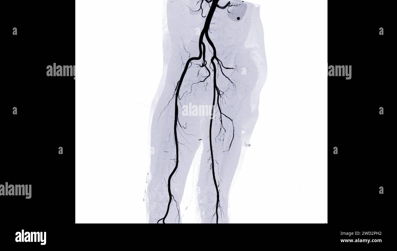 CTA femoral artery run off image of femoral artery for diagnostic Acute or Chronic Peripheral Arterial Disease. Stock Photo