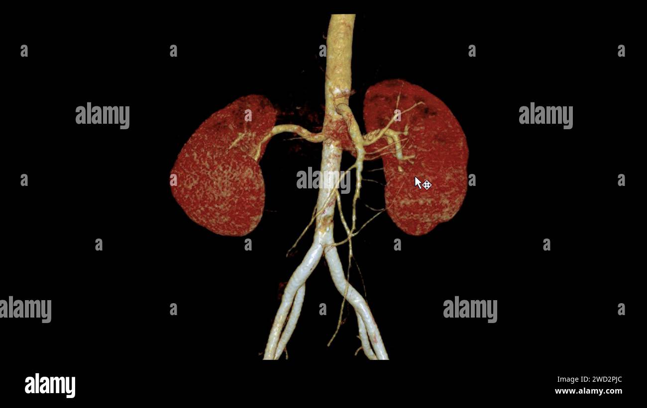 CTA Renal artery 3D is a medical imaging procedure using CT scans to examine the renal arteries It provides detailed images of the blood vessels suppl Stock Photo