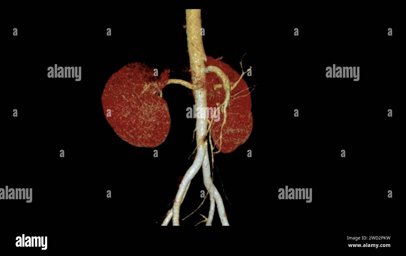 CTA Renal artery 3D is a medical imaging procedure using CT scans to examine the renal arteries It provides detailed images of the blood vessels suppl Stock Photo