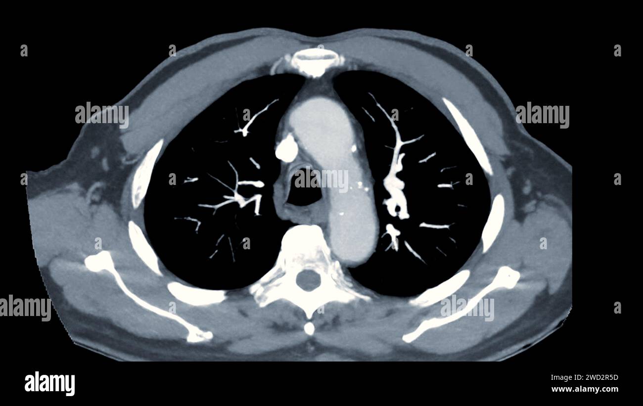 CTPA or CTA pulmonary artery .This imaging technique offers a clear view of the pulmonary arteries, aiding in the diagnosis of pulmonary embolism, vas Stock Photo