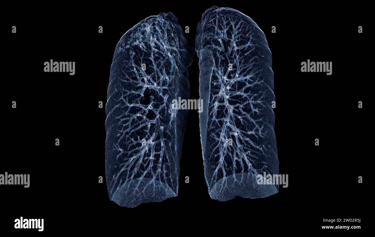 CT Chest or Lung 3d rendering image  showing Trachea and lung in respiratory system. Stock Photo