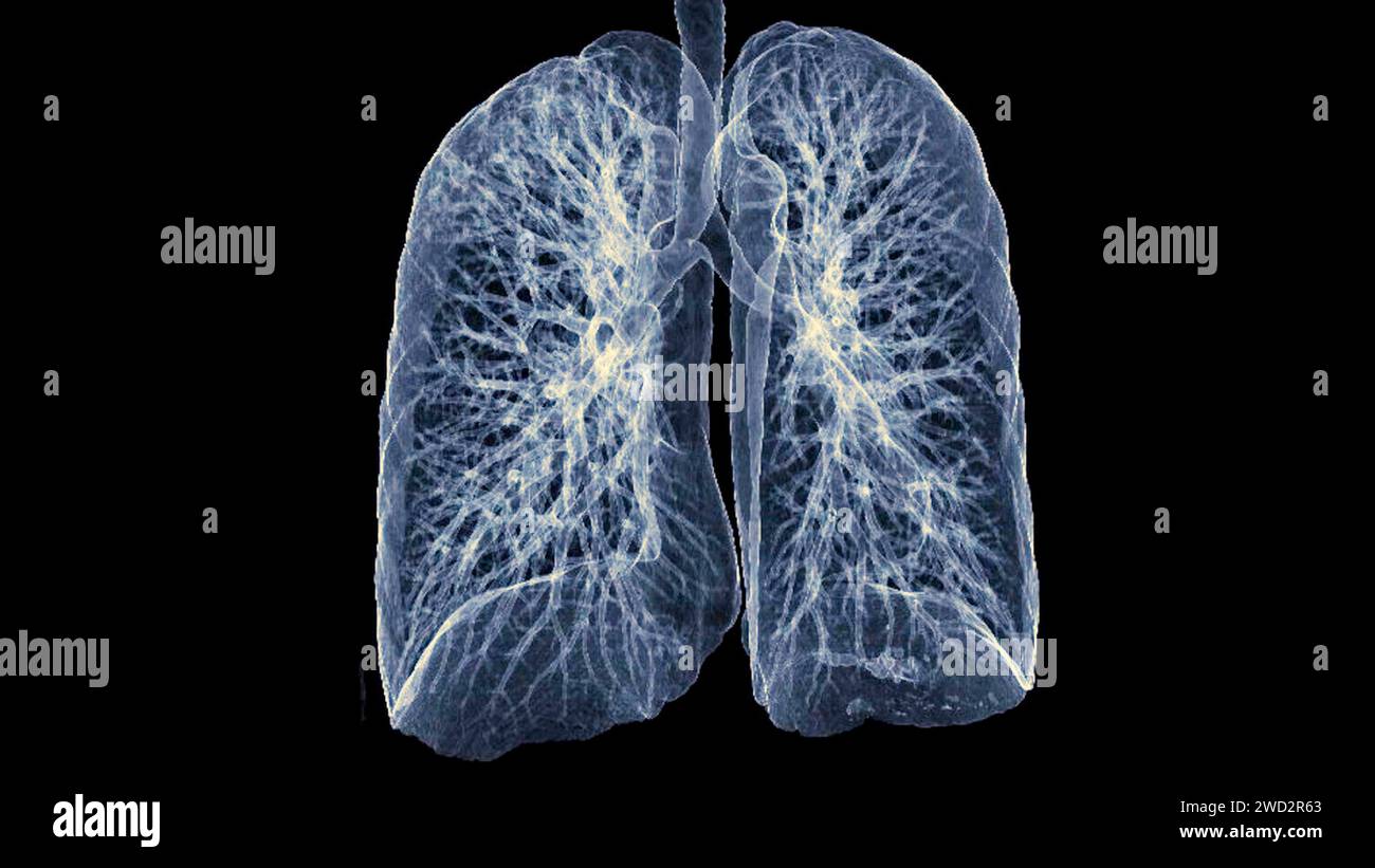 CT Chest or Lung 3d rendering image  showing Trachea and lung in respiratory system. Stock Photo