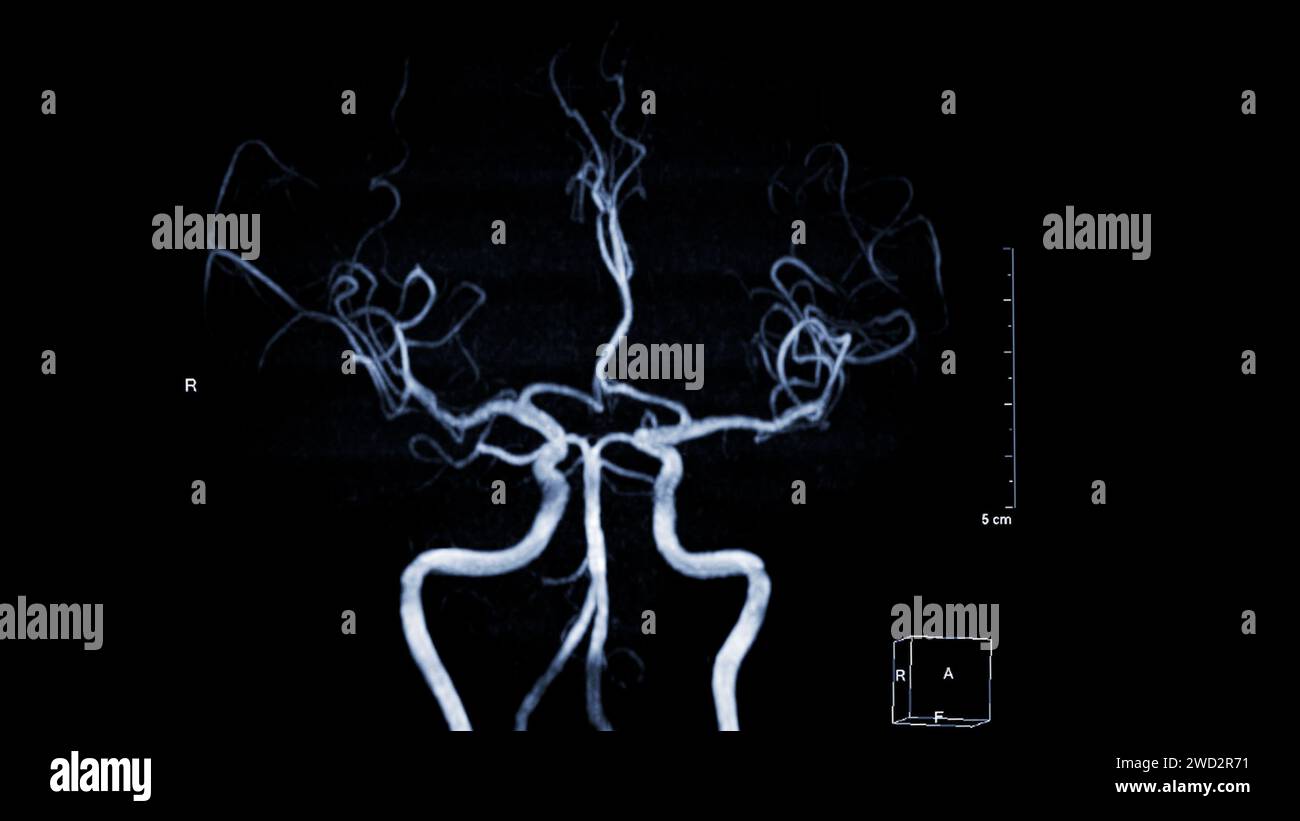 MRA Brain , This imaging technique provides clear visuals of the brain ...