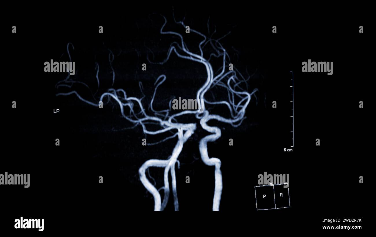 MRA Brain , This imaging technique provides clear visuals of the brain's arterial and venous structures, aiding in the diagnosis of vascular condition Stock Photo