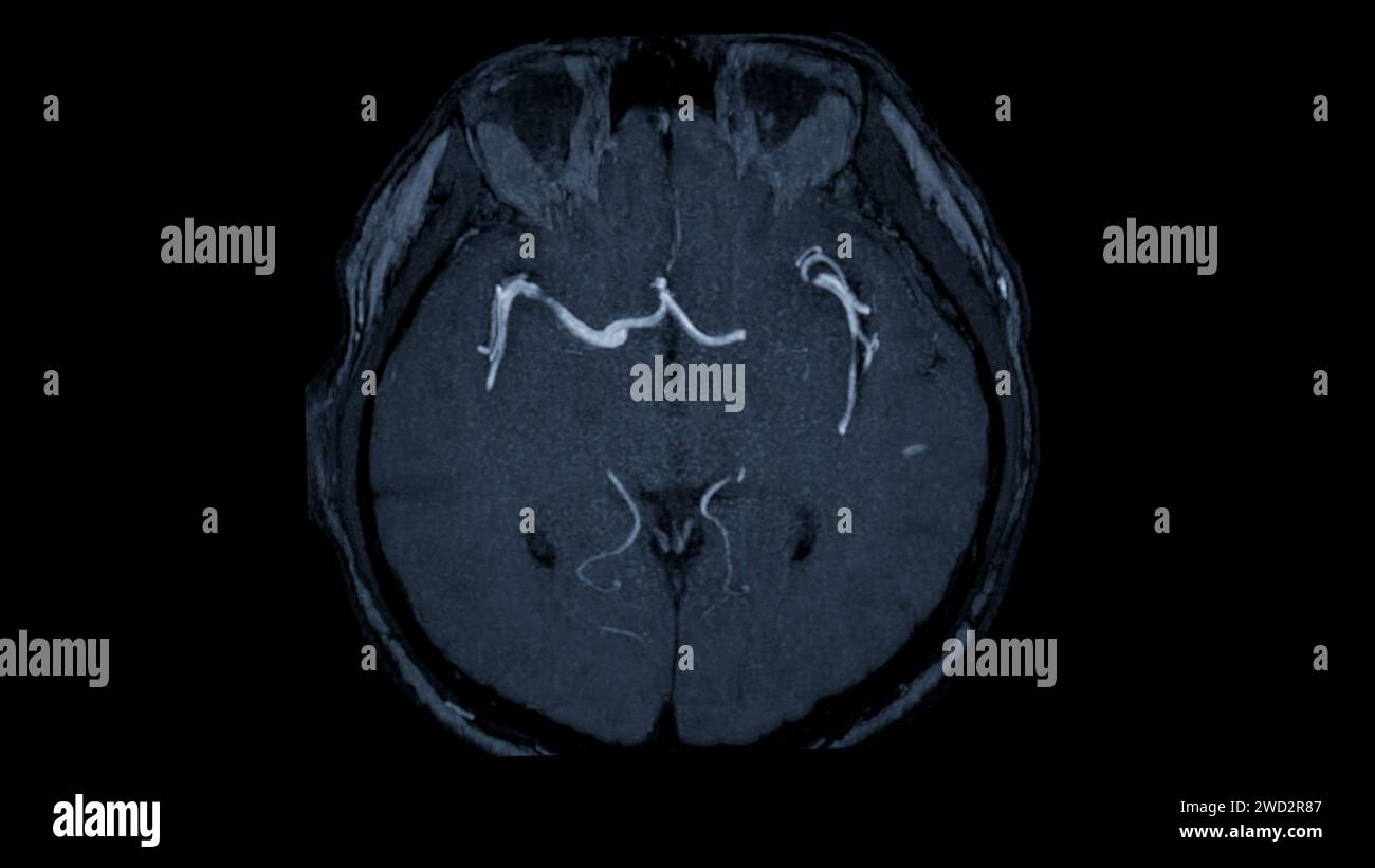 MRA Brain axial view , This imaging technique provides clear visuals of ...