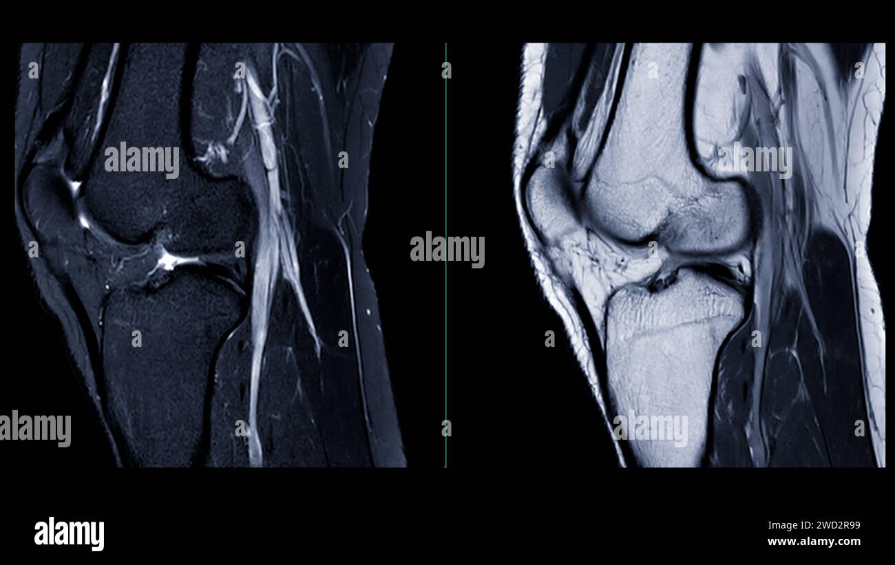 Magnetic Resonance Imaging Or MRI Of Knee Joint This Diagnostic magnetic-resonance-imaging-or-mri-of-knee-joint-this-diagnostic