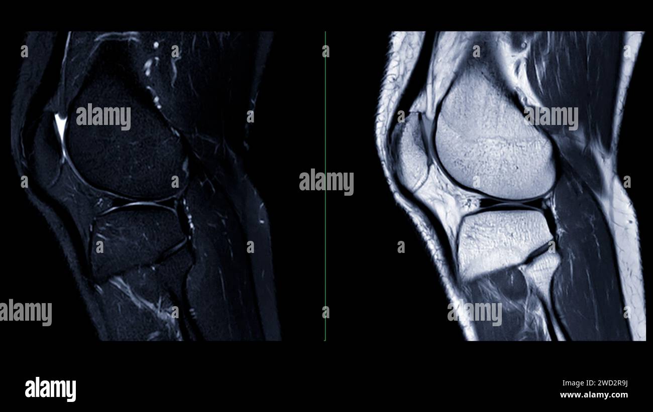 resonance imaging or MRI of knee joint. This diagnostic