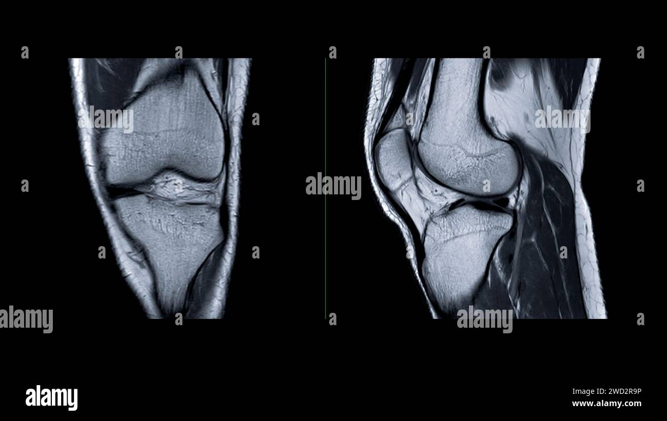 Magnetic resonance imaging or MRI of knee joint. This diagnostic ...