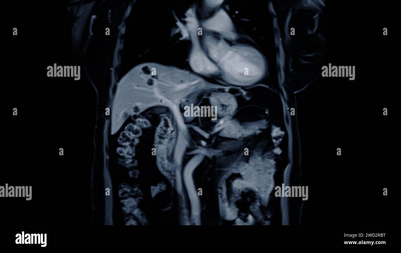 MRI of the upper abdomen coronal view is a non-invasive imaging technique providing detailed visuals of organs like the liver, pancreas, and kidneys. Stock Photo