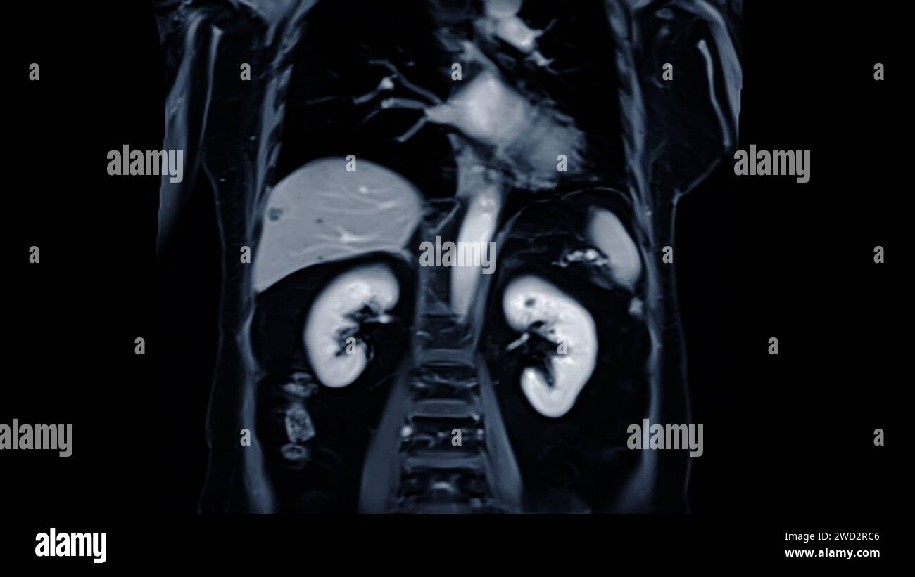 MRI of the upper abdomen coronal view is a non-invasive imaging technique providing detailed visuals of organs like the liver, pancreas, and kidneys. Stock Photo