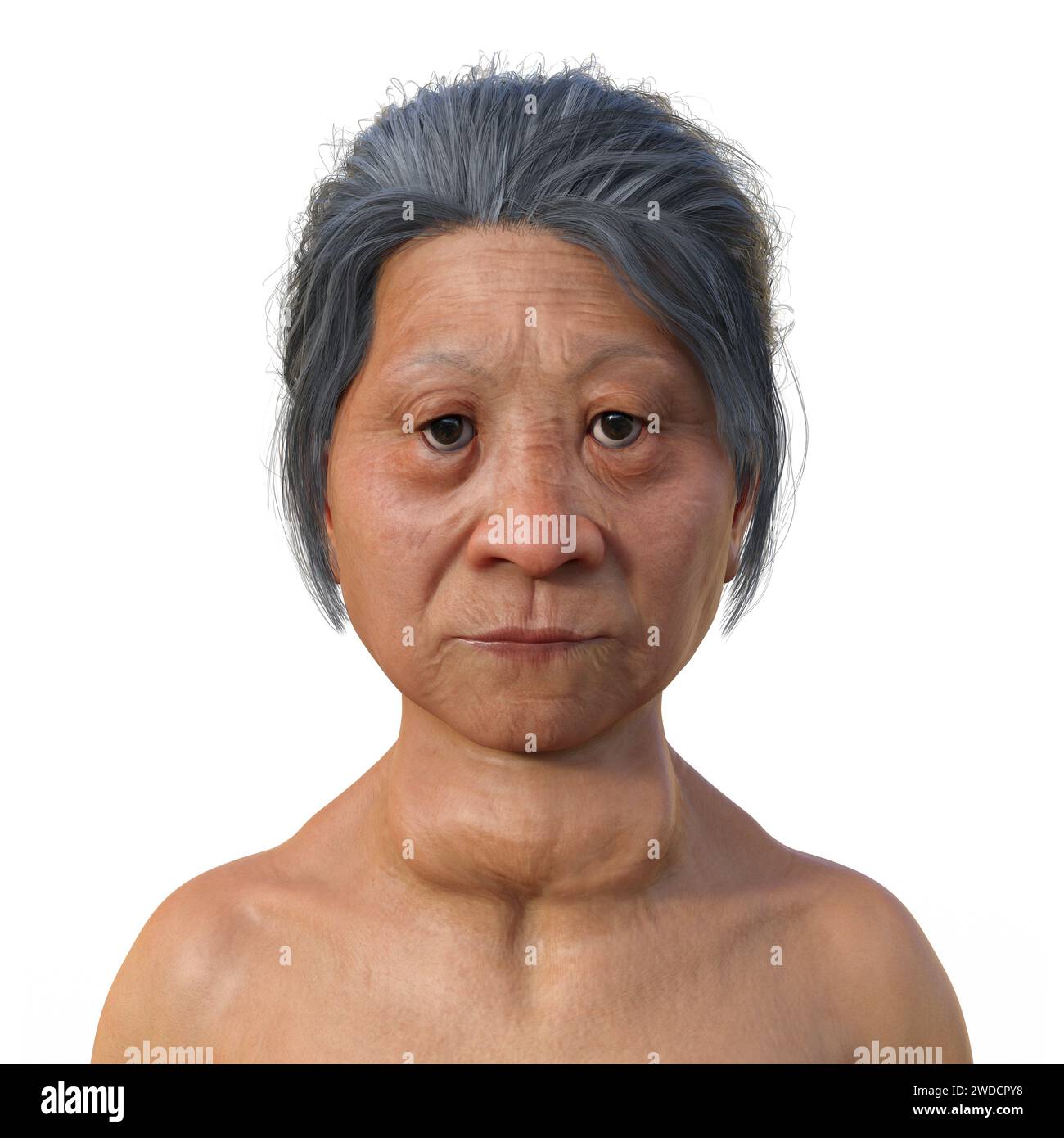 Graves' disease, illustration Stock Photo Alamy