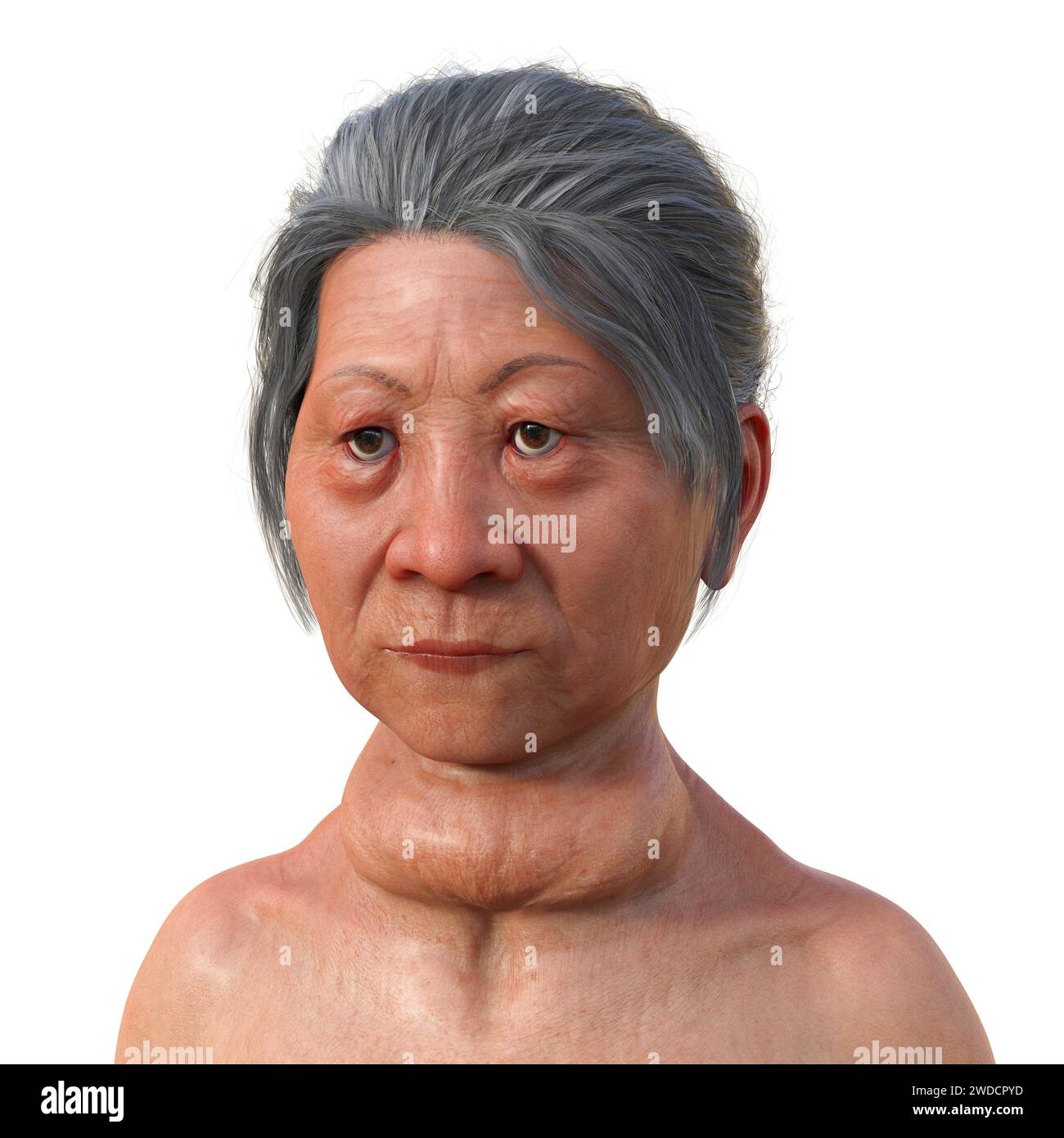 Illustration depicting a woman with Graves' disease, a condition which