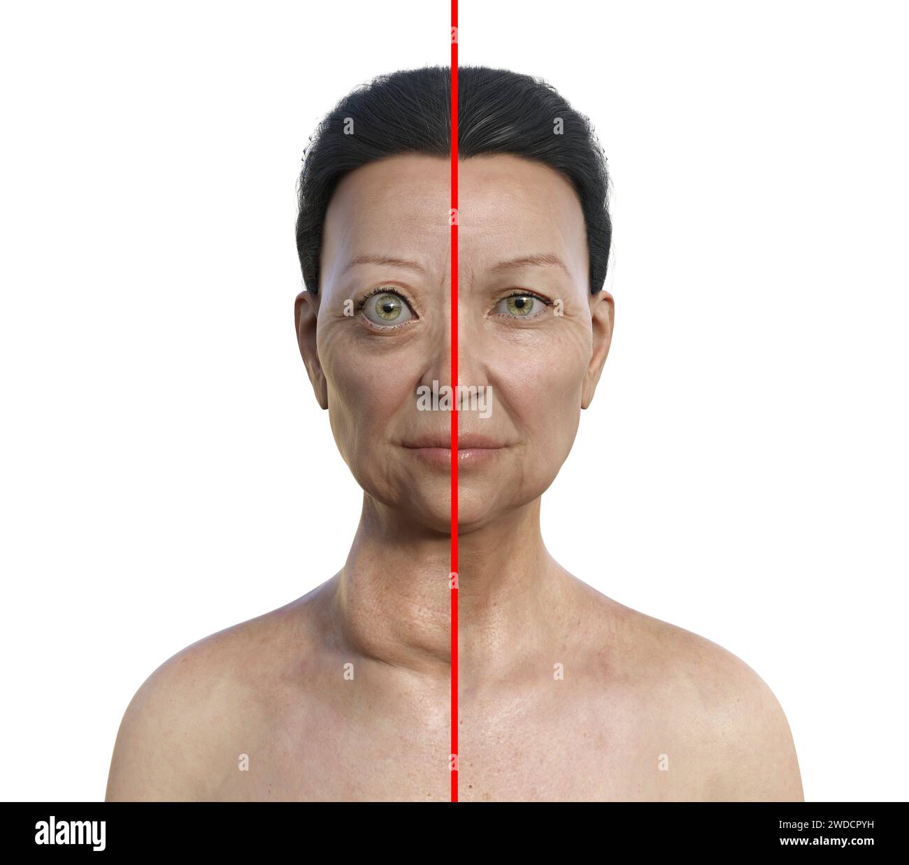 Illustration depicting a woman with Graves' disease showing an enlarged