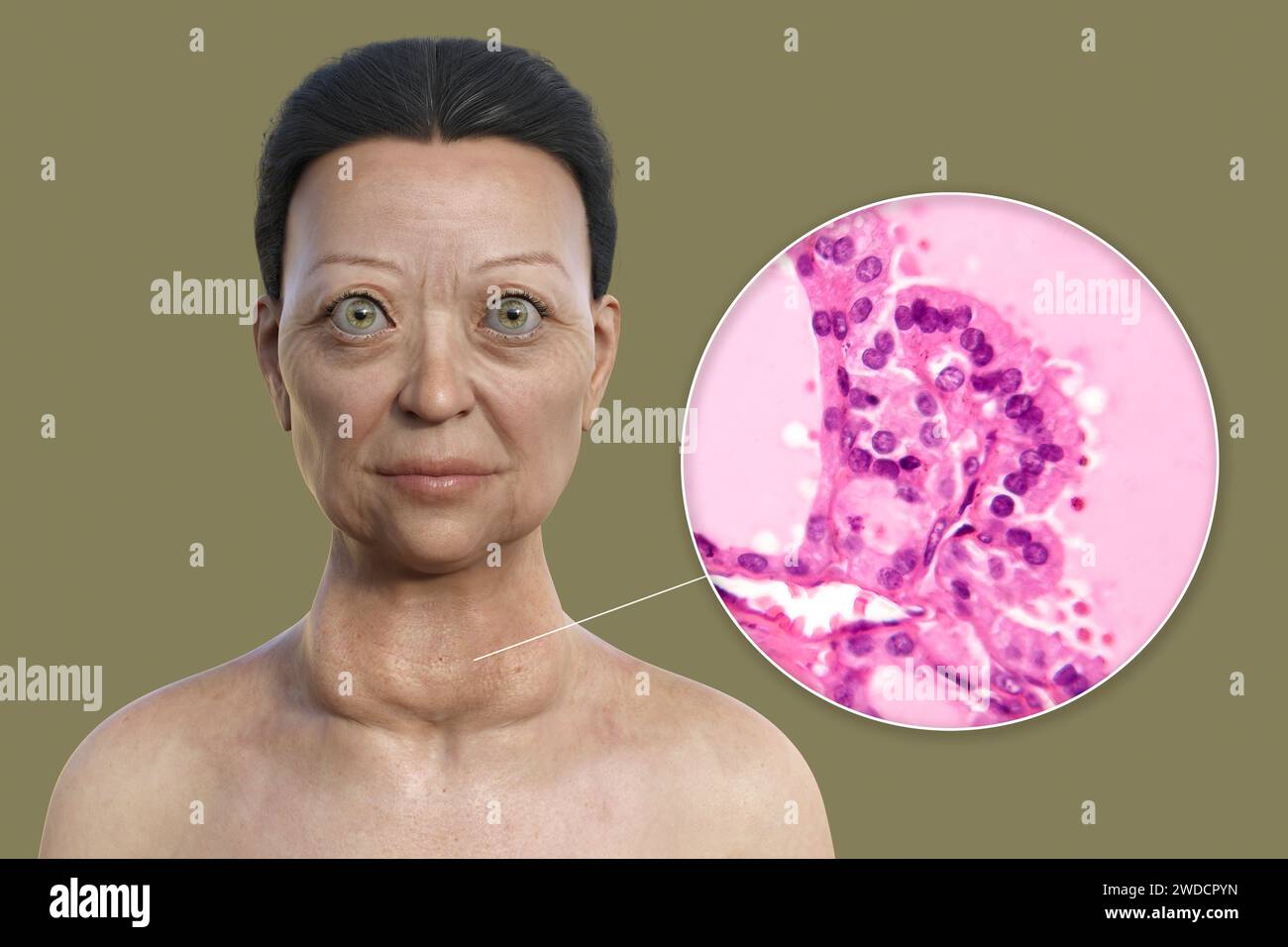 Illustration depicting a woman with Graves' disease showing an enlarged