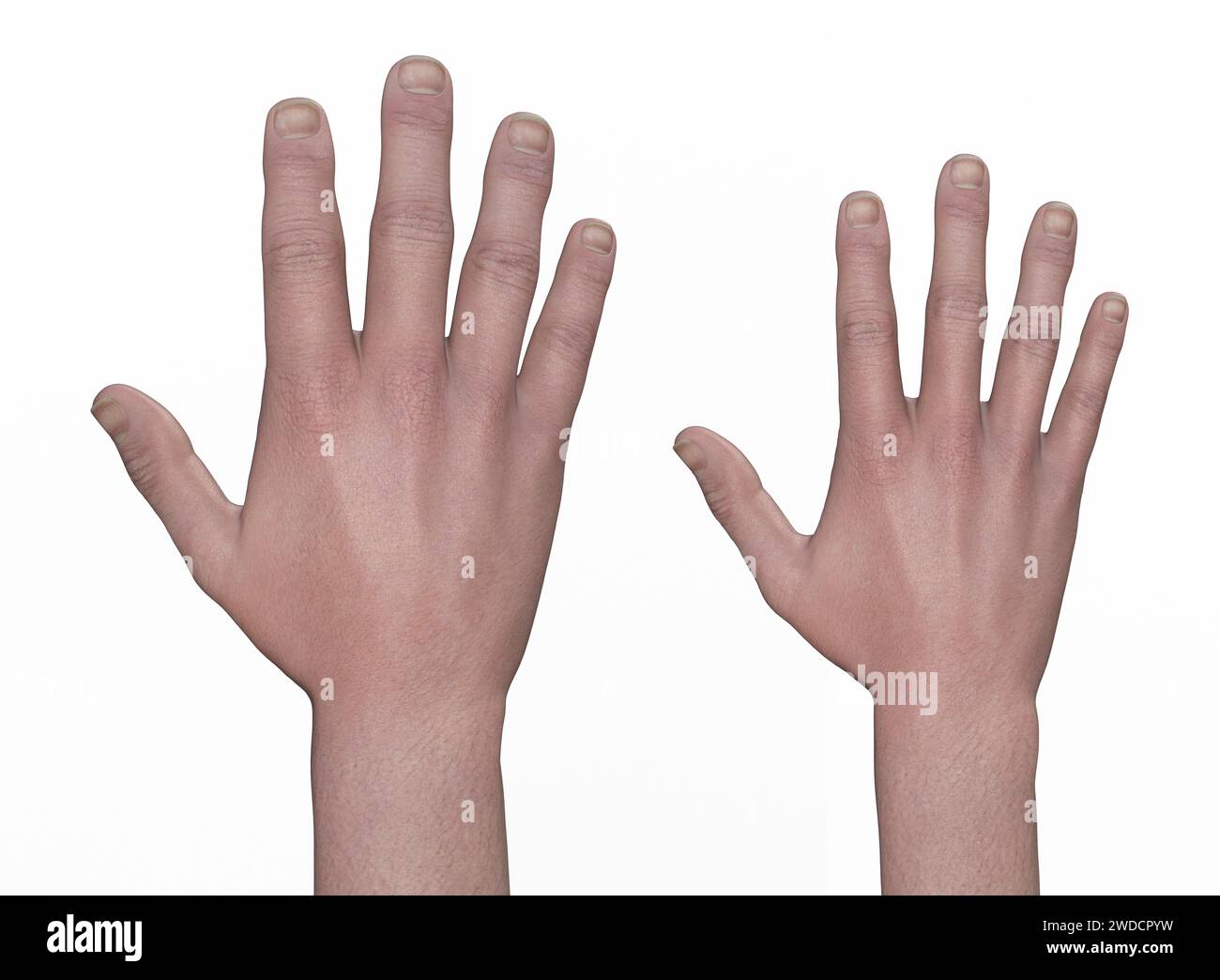 Hand with acromegaly compared to healthy hand, illustration Stock Photo