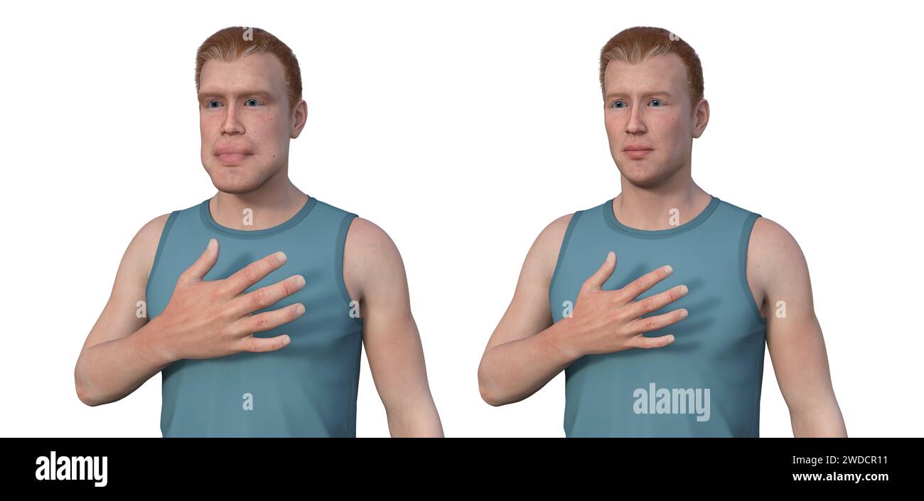 Acromegaly in a man compared to healthy man, illustration Stock Photo ...